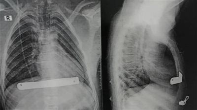 فريق طبي بمستشفى بنها الجامعي يُجري عملية تصليح قفص صدري لشاب