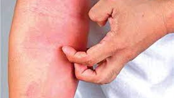 التهاب الجلد