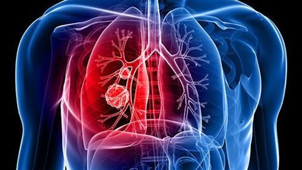 سرطان الرئة