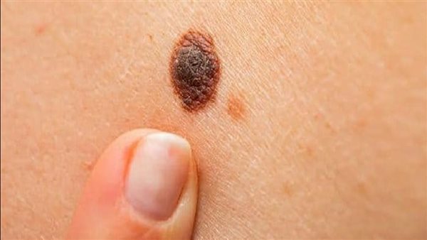 سرطان الجلد ـ أرشيفية