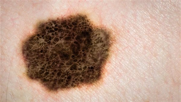 شامة الورم الميلانيني