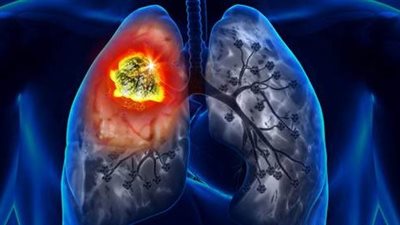 تتشابه أعراضه مع كورونا.. سيدة تروي تفاصيل إصابتها بسرطان الرئة