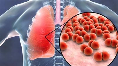 تأثيرات سلبية على المناعة.. ما علاقة النزلة الشعبية الحادة بالطقس الحار؟