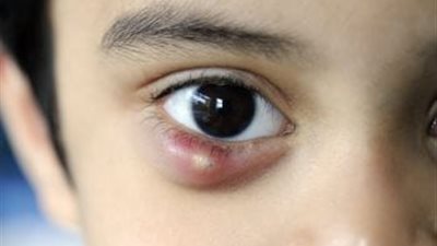 نصائح للوقاية من البردة التي تصيب العينين