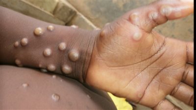 مدينة أمريكية تشهد ارتفاعا قياسيا في إصابات فيروس جدري القرود