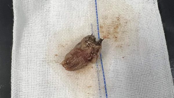 قطعة فراولة أدت لانسداد