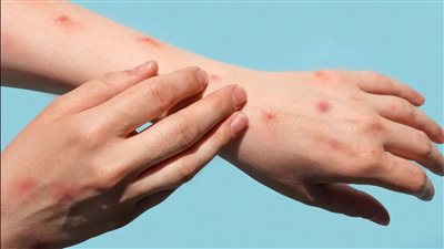 بعد انتهاء حالة الطوارئ العالمية.. مدينة أمريكية تشهد موجة جديدة من فيروس جدري القرود