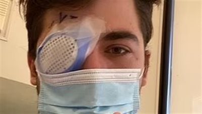 بكتيريا آكلة للحم.. شاب أصيب بالعمى بعدما نام بعدسات لاصقة