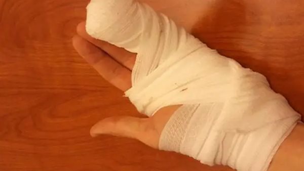 بتر إصبع _ أرشيفية