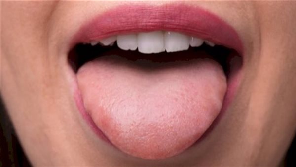 سرطان الفم ـ أرشيفية