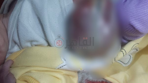 ولادة طفل بأمعاء