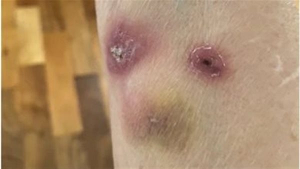 مرض جلدي نادر