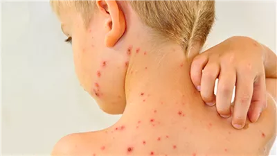 أمريكا تسجل ارتفاعا في حالات الإصابة بالحصبة 