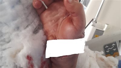 استغرقت 12 ساعة.. معهد ناصر ينجح في إعادة توصيل كف يد شاب تعرضت لبتر كامل باستخدام جراحة الميكروسكوب