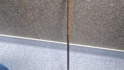 مستشفى الحسين الجامعي ينجح في استخراج سيخ حديد من بطن طفل 9 سنوات | صور 