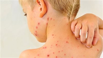 95% من المصابين غير ملقحين.. تفشي الحصبة في الولايات المتحدة يصل لمستويات مرعبة