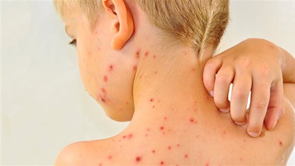 الحصبة - أرشيفية