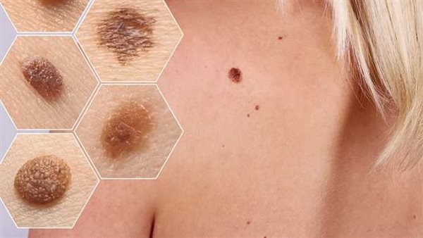 تعرف على أعراض سرطان الجلد الأقل شيوعًا