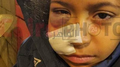 إصابة طفلة سقطت عليها قطعة حديدية من لعبة عملاقة داخل النادي الأهلي