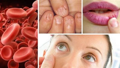 أبرزها جفاف الجلد.. علامات نقص الحديد في الجسم