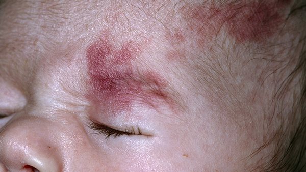 طفل مصاب بمتلازمة