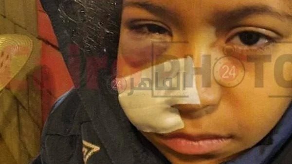 طفلة تعرضت لإصابة