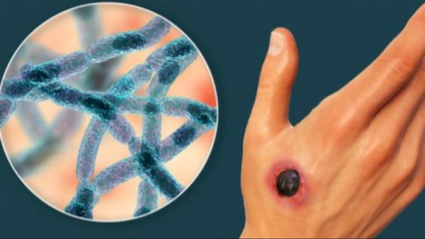 وباء الجمرة الخبيثة