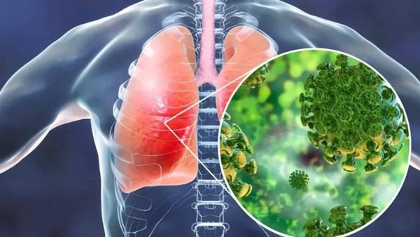 عدوى داء السل ـ أرشيفية