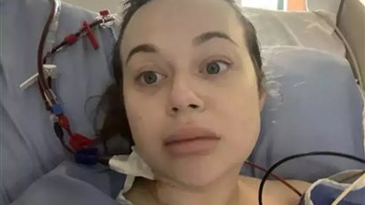 تعفن قدم سيدة بعد احتساء الخمر لاستلقائها عليها طوال الليل دون وعي