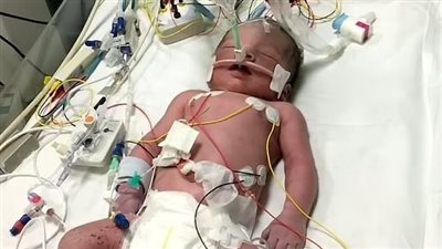 نصحها المسعفون بأخذ حمام دافئ.. إصابة رضيع بريطاني بالشلل الدماغي في رحم أمه 