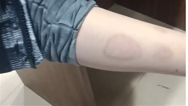 جزء من حروق الطفل