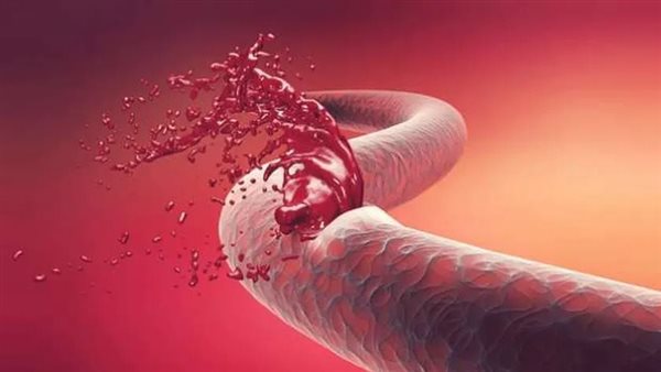 الهيموفيليا 