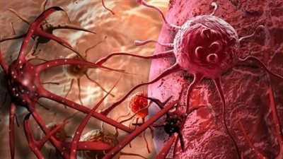 أعراض شائعة مرتبطة بحالات مرضية معتادة قد تشير لخطر الإصابة بالسرطان .. تعرف عليها 