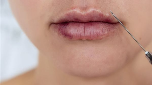 حقن الفيلر والبوتكس