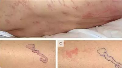 الديدان تزحف تحت جلده.. عامل إسباني يُصاب بعدوى نادرة